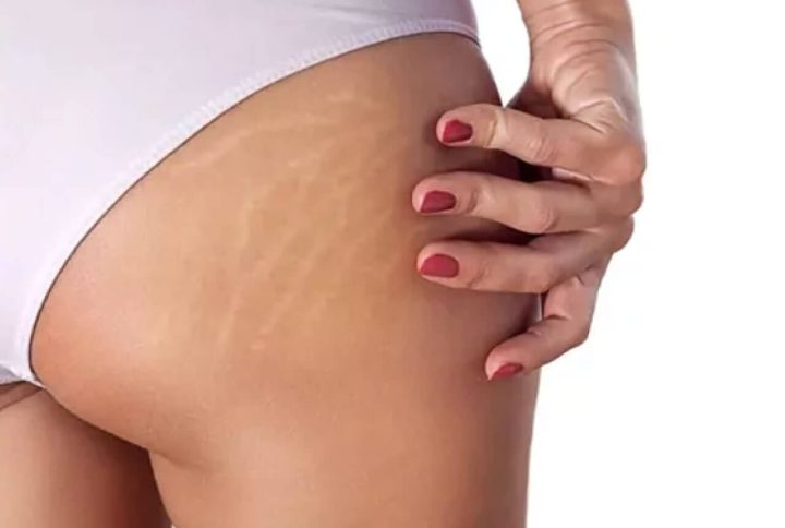 Cómo mantener la salud de la piel en una mujer embarazada